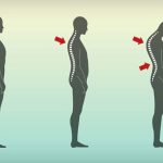 Gù lưng có ảnh hưởng đến chiều cao không?